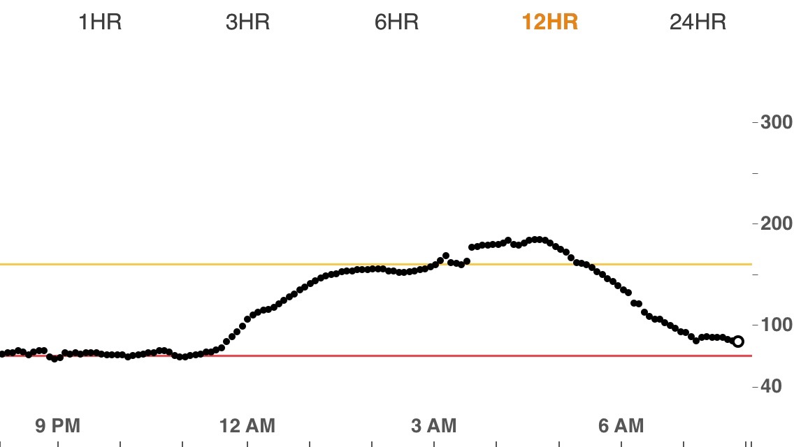 Blood sugar effects of cortisone shots Diabetes Stories